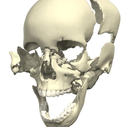 disarticulated skull medical images universal images group